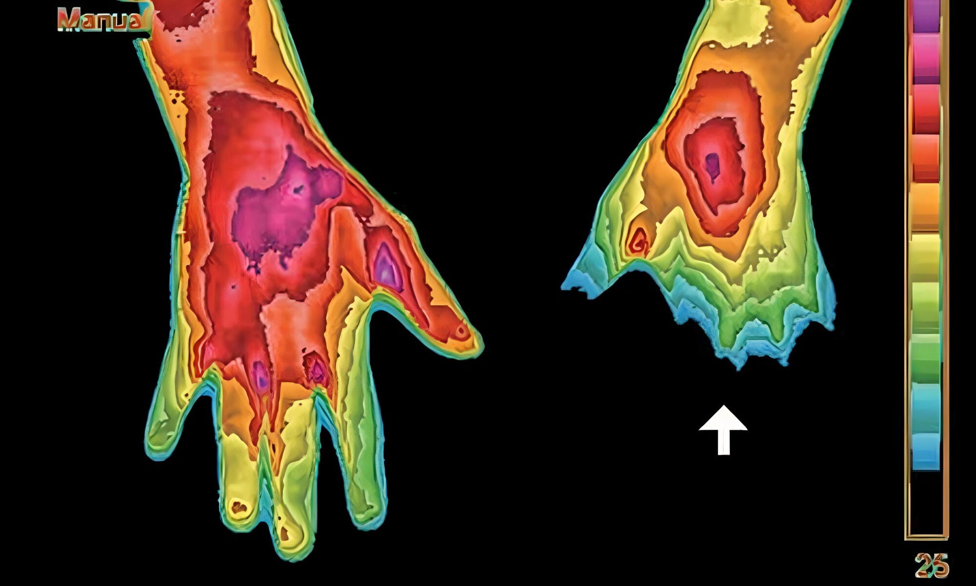 Colorized thermal imaging of a person's feet with a color scale on the side.