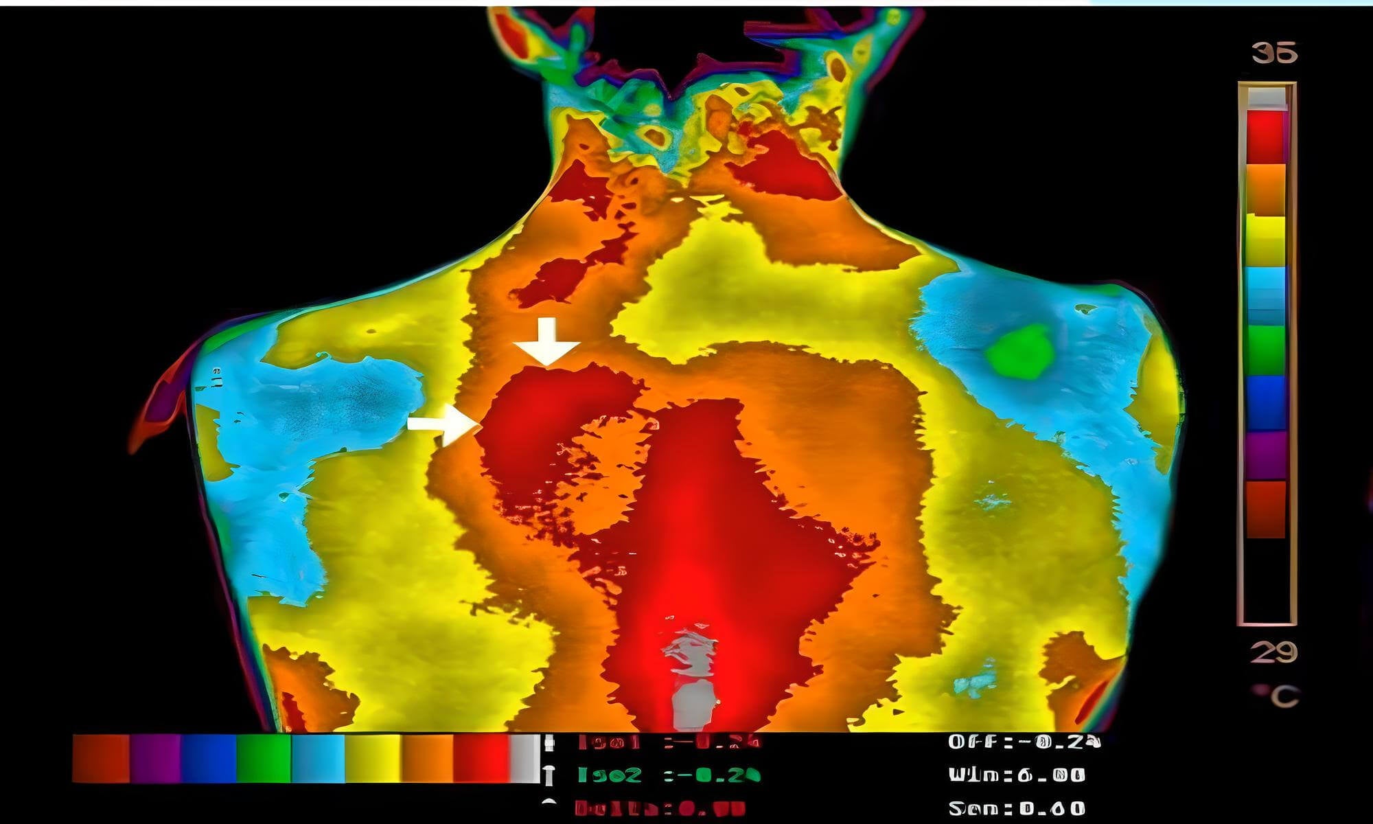 Thermal scan showing back inflammation areas